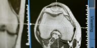 Close-up of an MRI scan displayed on a medical monitor, showcasing diagnostic medical imaging technology.
