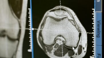 Close-up of an MRI scan displayed on a medical monitor, showcasing diagnostic medical imaging technology.