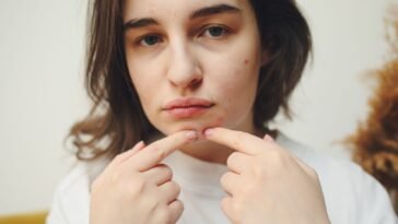 Real Talk: Does Creatine Actually Give You Acne?