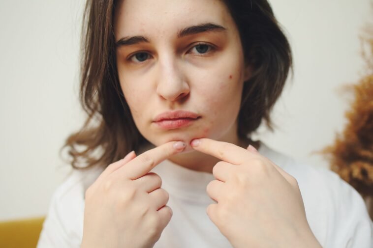 Real Talk: Does Creatine Actually Give You Acne?